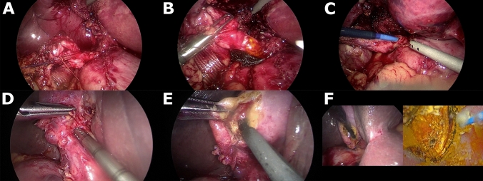 Enhanced Surgical Technique (EST). A-C, correction of the cysticocholedochal angle. D-F, Trans-infundibular Approach (TIA) to the common bile duct