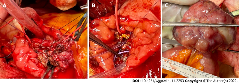 Intraoperative images. A: A broad base ampullary mass with red Fogarty catheter was advanced from the cystic duct down through the ampulla to the duodenum; B: The ampullary mass was excised, and two internal stents were placed in the bile duct and pancreatic duct in addition to the red Fogarty catheter in the bile duct; C: Pedunculated gastrointestinal stromal tumor arising from the small bowel approximately 150 cm proximal to the ileocecal valve.