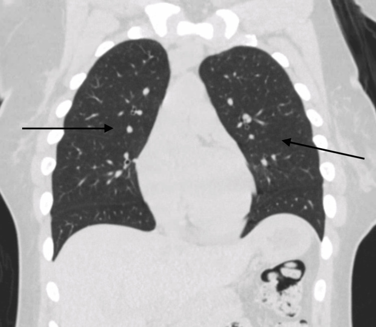 Repeat computed tomography of the chest two months later. Black arrows showing complete resolution of ground-glass opacities