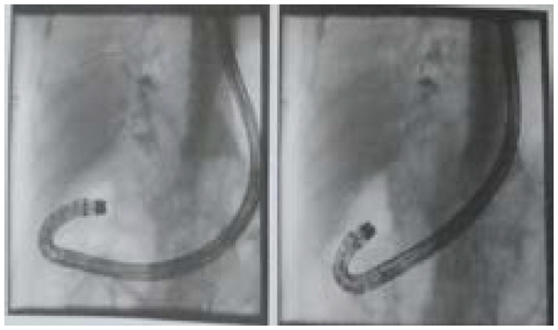 ERCP showing reflex oesophagitis LAC, stented CBD and choledocholithiasis with choledochoduodenal fistula