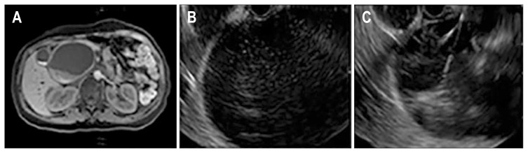 After a large cystic dilatation was found on magnetic resonance imaging (A), an endoscopic ultrasonography (EUS) image was obtained (B), and simultaneous EUS-guided fine-needle aspiration was performed (case 12) (C).