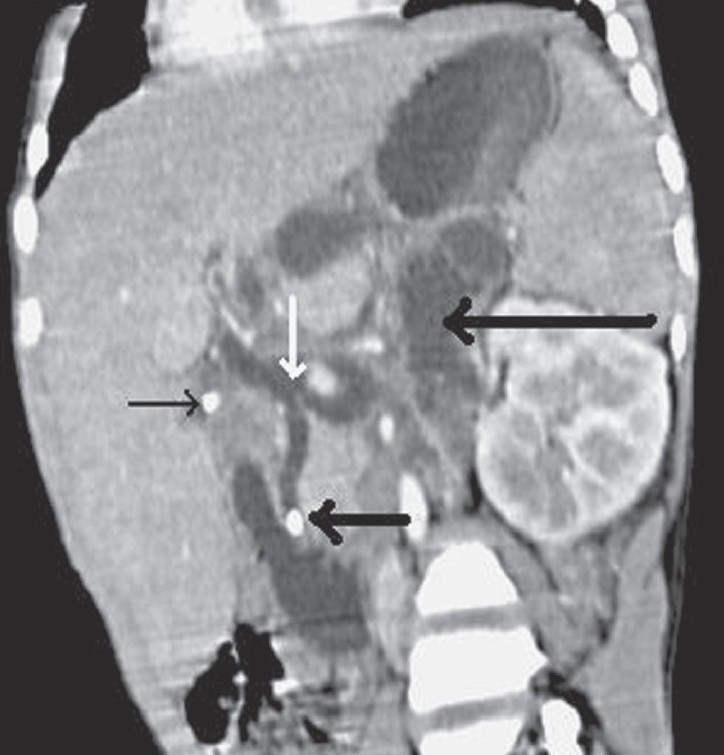 Oblique coronal MPR contrast-enhanced CT scan shows a calculus in the distal part of the CBD (thick black arrow), with proximal dilatation and a calculus in the neck of gallbladder (thin black arrow). In addition there is frank communication (white arrow) between the extrahepatic suprapancreatic CBD and retroperitoneal collections, lying between the left kidney and the pancreas and pushing the stomach superiorly (large black arrow)