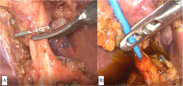 Intraoperative imaging of one‐stage laparoscopic transcystic papillary balloon dilation and laparoscopic cholecystectomy. A, The common bile duct is cut halfway around the circumference. B, A BRITE TIP sheath introducer is inserted into the cystic duct