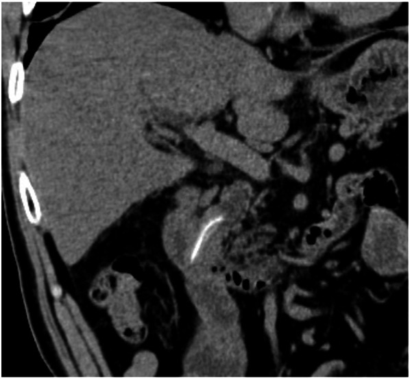 The coronal plane computed tomography (CT) image showing a common bile duct (CBD) stone along the length of the CBD, with a needle-shaped calcification density at the center