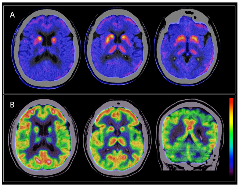 50-year-old woman with a history of Parkinsonism that began 2 years ago, characterized by tremor in the upper limbs, more accentuated in the right side, bradykinesia, REM sleep behavior disorder, and nocturia. At the movement disorders clinic, she was diagnosed with Parkinson’s disease. Dual cerebral PET/CT was performed: (A) FDOPA PET shows a severe decrease in the uptake of the putamen nuclei, predominantly in the left side. (B) FDG PET shows severe hypometabolism in both putamen nuclei, which was also worse in the left side; preserved metabolism in the cerebral cortex and cerebellum. The findings described are consistent with MSA-P diagnosis.