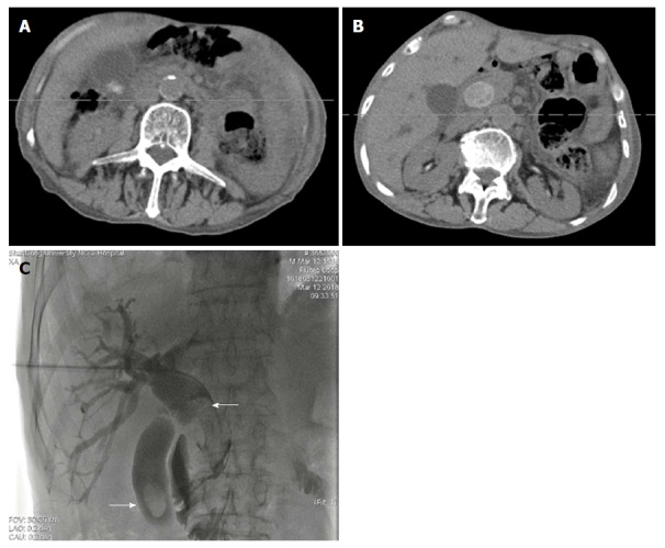 Computed tomography scan and cholangiography showing filling defect in the common bile duct and gallbladder (white arrow). Dilation of the common bile duct and cystic duct was detected. A and B: Ultrasonography, enhanced computed tomography, magnetic resonance cholangiopancreatography, or cholangiography was carried out to determine the diagnosis of stones; C: Advancing cholangiography was performed to detect the number, size, and location of stones.