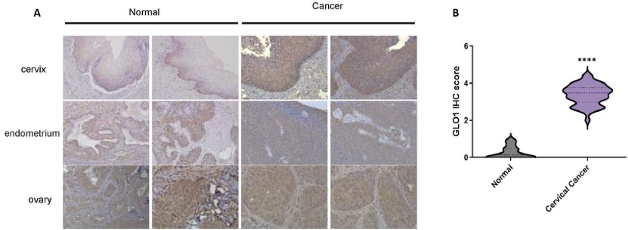 Upregulation of GLO1 in Cervical Cancer Tissues.(A) Representative staining of GLO1 in cervical cancer and normal tissues (200x magnification). (B) Comparative GLO1 IHC scores in cervical cancer versus normal tissues. Statistical significance was determined using the t-test (**** p<0.0001).