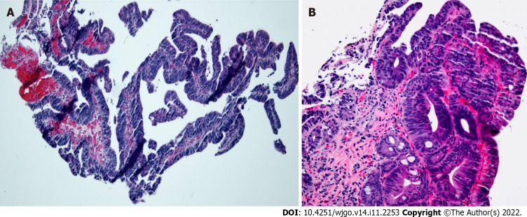 Histopathology of endoscopic biopsy. A: Medium-power photomicrograph demonstrating dysplastic glandular epithelium with a tubulovillous architecture (hematoxylin and eosin stain, 100 × original magnification); B: High-power photomicrograph showing high-grade glandular dysplasia (hematoxylin and eosin stain, 200 × original magnification).