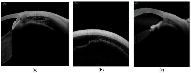 Anterior segment swept-source OCT. Ciliary body detachment between three types of fibers (a); supraciliary fluid in four quadrants in varying volume (b) and in the pars plicata (c).