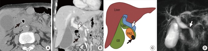 Computed tomography (CT) and magnetic resonance cholangiopancreatography (MRCP) findings of the biliary tract. On axial CT scan, a high attenuated stone density with internal air (black arrow) is seen on distal common bile duct (CBD) (A). However, coronal reconstructed image shows that the stone (black arrow) is not located in the CBD but within the periampullary diverticulum that is filled with air and debris along with mid CBD stricture (white arrow) (B). This finding is depicted in line art to better delineate the anatomical relationship (C). Absence of CBD stone and mid CBD stricture is also demonstrated on MRCP image (D).