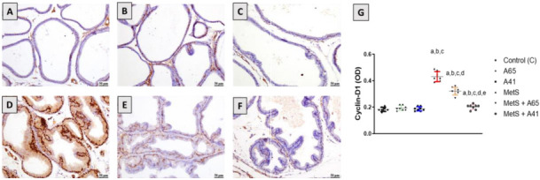 Photomicrographs showing the effect of AM6545 or AM4113 treatment on the prostate expression of cyclin D1 in MetS-induced BPH in rats. The MetS rats were treated with 10 mg/kg AM6545 or AM4113 daily for 4 weeks. The concentration of cyclin D1 expression was determined by immunohistochemistry. (A) Control group; (B) AM6545-treated group (A65); (C) AM4113-treated group (A41); (D) MetS group; (E) MetS rats cotreated with AM6545 (MetS + A65); (F) MetS rats cotreated with AM4113 (MetS + A41); (G) Quantification of cyclin D1 expression in the prostate in all groups. Scale bar (50 µm). Results are displayed as mean ± SD (n ═ 8). a, b, c, d, or e indicates a significant difference from the control, A65, A41, MetS, or MetS+A65 groups, respectively, at P < 0.05 employing one-way ANOVA followed by Tukey’s post hoc test. MetS: Metabolic syndrome; BPH: Benign prostatic hyperplasia; ANOVA: Analysis of variance.