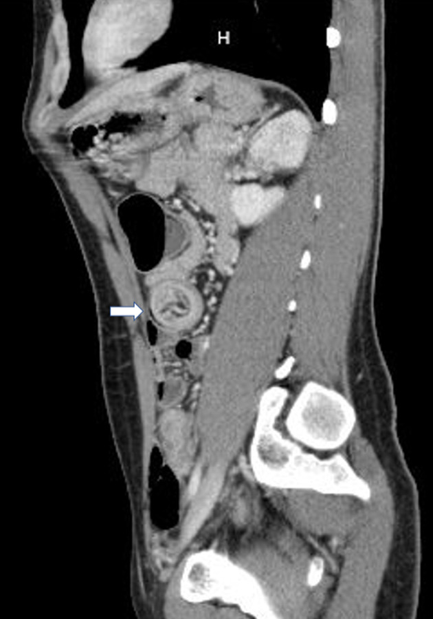 Computed tomography (CT) scan (sagittal with arrow) showing jejuno-jejunal intussusception in the left mid-abdomen with colon wall thickening.