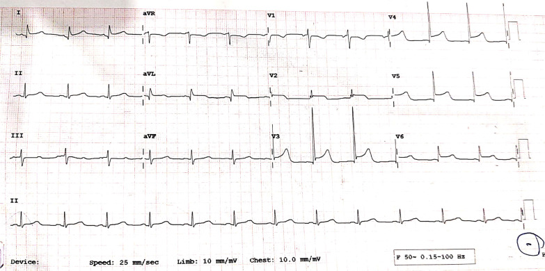 ECG at initial presentation—showing ST segment elevation in the leads I, aVL, V4, V5, and V6 leads