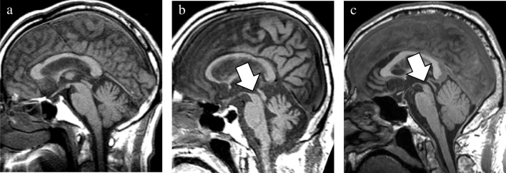 Visual rating scale of midbrain atrophy. The degree of midbrain atrophy was assessed using the three-point scale (0 = normal, 1 = mild, and 2 = severe). Compared with the normal midbrain in a patient with pathologically confirmed AD (a), mild midbrain atrophy showing a slight decrease in anteroposterior and/or superoinferior diameters was observed in a patient with pathologically confirmed CBD (b). By contrast, a definite decrease in these diameters was classified as severe midbrain atrophy in a patient with pathologically confirmed PSP (c). AD, Alzheimer’s disease; CBD, corticobasal degeneration; PSP, progressive supranuclear palsy