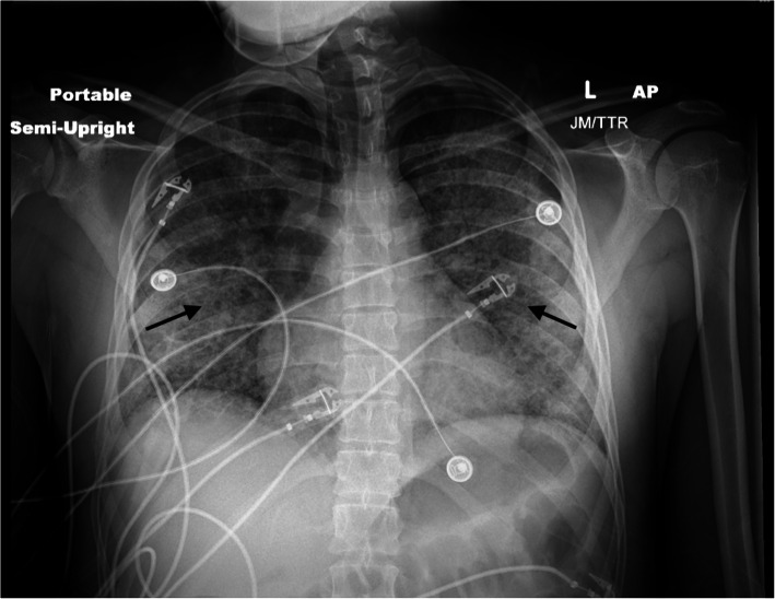 Chest x-ray demonstrating diffuse central predominant interstitial opacities (black arrows)