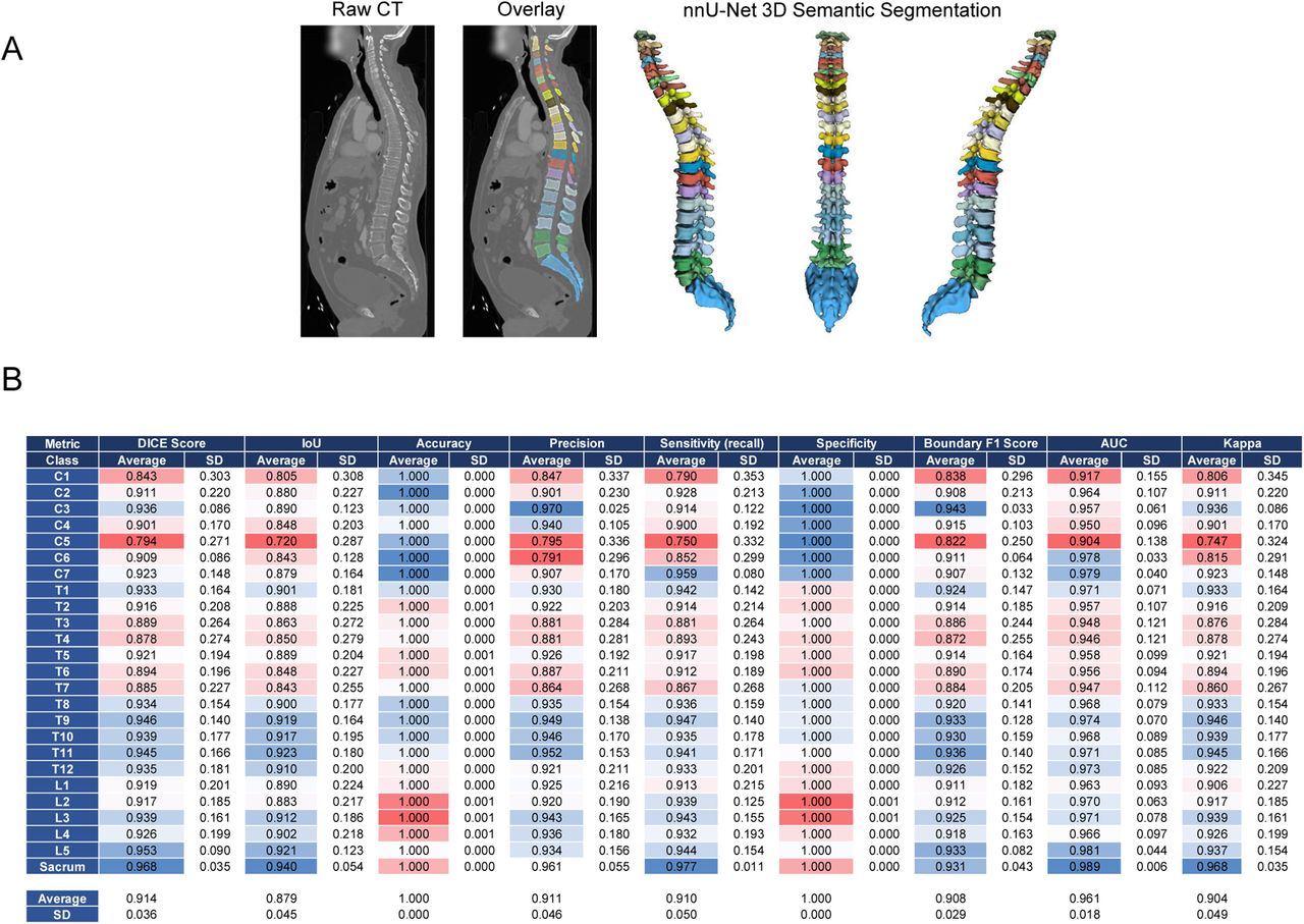 SpineCT-nnUNet spine segmentation model predictions and segmentation metrics.(A) Example of segmentation results with the nnU-Net framework derived model (3D-full resolution) in both 2D and 3D visualizations. Vertebrae are color coded. The entire human spine is represented in the image: cervical spine (C1-C7), thoracic spine (T1-T12), Lumbar spine (L1-L5) and sacrum. (B) Validation metrics for spineCT-nnUNet spine segmentation model. Color encodes the accuracy of segmentation class predictions. Blue indicates high similarity to the ground truth, while red represents increasing deviation from the actual values.