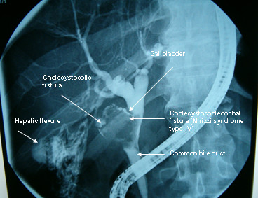 Endoscopic retrograde cholangiopancreatography. Severe common bile duct stenosis, with wide cholecystocholedochal communication. A shrunk gallbladder with a large gallstone and a secondary formation of a fistoulous tract, the right hepatic flexure with the contrasted colonic haustration are the highlights of this image modality.