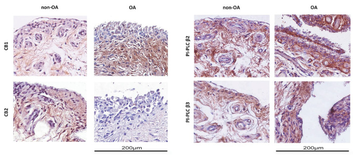 Immunohistochemical analysis of synovial membranes from OA (osteoarthritis) and non-OA patients. Left panel: Slices were stained with anti-CB1 and anti-CB2 receptor antibodies. Right panel: Slices were stained with anti-PI-PLC β2 and anti-PI-PLC β3 antibodies. Slides were counterstained with hematoxylin and mounted with permanent mounting media. This figure shows representative images of different experiments (n = 5 non-OA and n = 6 OA).