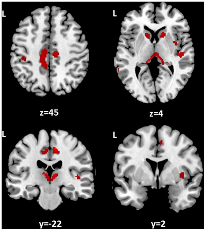 Association between lesion load and GM atrophy in MS brain.There are shown here in red, those brain areas in which local GM volumes are negatively associated with T2-weigthed lesion loads in the whole MS population. This association indicates that MS patients with larger lesion load tend to develop more GM atrophy in the thalamus, the head of the caudate nucleus and the cingulate cortex bilaterally, in the right insular cortex, and in the left postcentral gyrus. Statistical threshold: p values FWE-corrected <0.05. Spatial coordinates (x,y,z) in the figure are in MNI space.