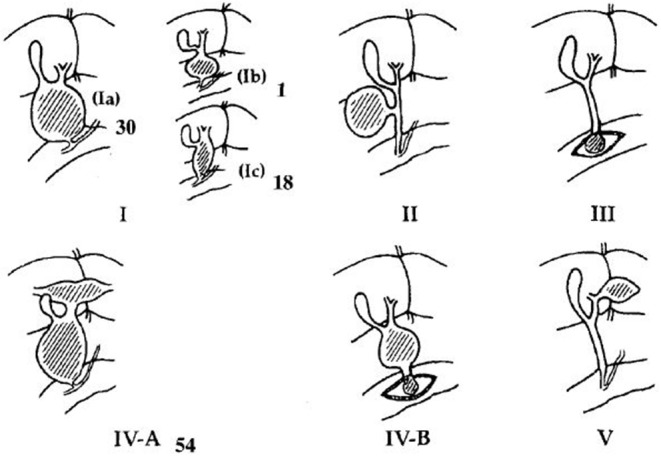 Todani's classification of choledochal cyst.