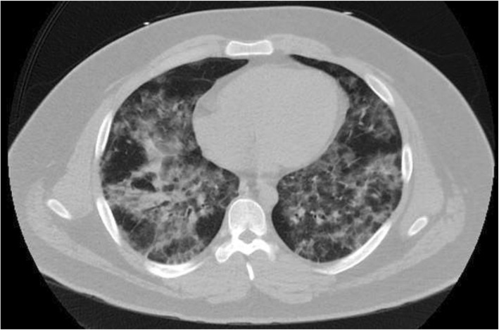 Axial CT Chest without IV Contrast: Diffuse interlobular septal thickening and ground-glass opacities involving the bilateral lung fields