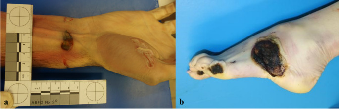 Electrical contact marks on the right hand and wrist (a), with marks from electrical current exit on the left foot (b)