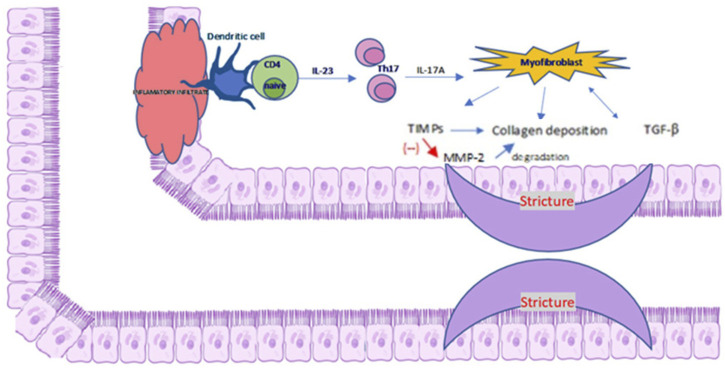 Diagram illustrating the process of intestinal stricture formation. It shows CD4 naïve cells interacting with dendritic cells, leading to the creation of Th17 cells. This releases interleukins IL-23 and IL-17A, activating myofibroblasts, which cause collagen deposition and TGF-beta production. TIMPs inhibit MMP-2 degradation. The resulting inflammation and fibrosis are represented as narrowed segments labeled "stricture."