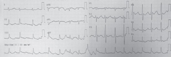 Osborn waves and atrial fibrillation was also observed in the patient's ECG after 2 h of observation (body temperature, 35°C)
