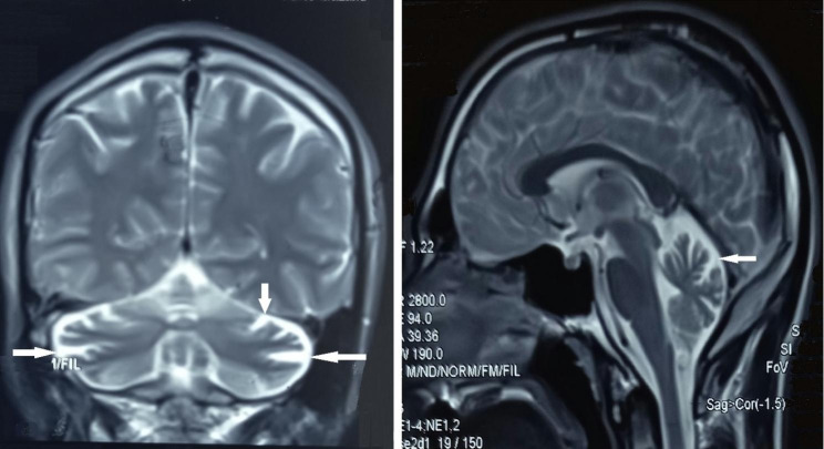 Brain MRI of patient IV.I showing cerebellar atrophy (arrows)