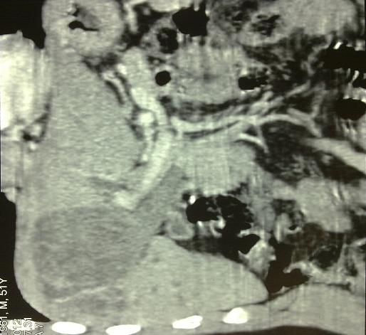 Abdominal CT showing hydatid cyst of 4th & 5th segments of liver communicating wit dilated CBD