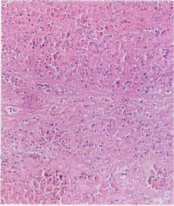 Histopathological examination revealed that the clot was composed of massive red blood cells and white blood cells with fibrin exudation and tissue necrosis