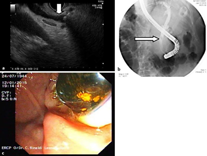 a EUS image showing a stone inside the normal caliber of the CBD. b Fluoroscopy image during ERCP procedure showing the normal caliber of the CBD with a stone in situ. c Endoscopy image showing that a large stone was extracted through the papilla.
