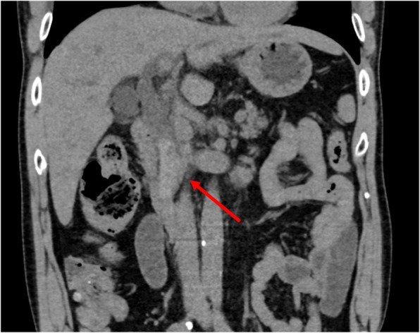 Plain CT scan image on admission. Coronal section of plain CT showing the high-density area in the CBD (arrow) and the dilation of the CBD and intrahepatic bile duct