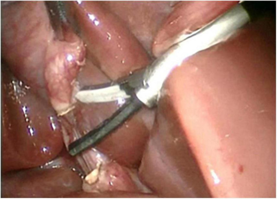 Both ends of the cystic duct after being cut by harmonic shear.