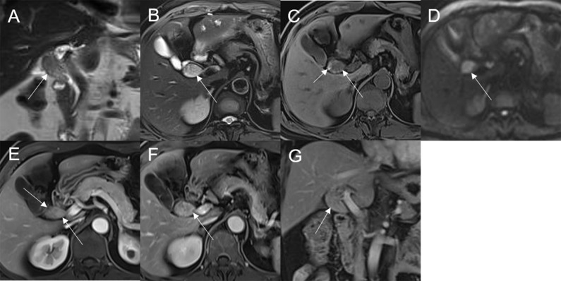 Adenoma in the common bile duct. The eccentric mass (white arrow) with a frond-like superficial appearance shows hyperintensity on T2WI (A, B), hypointensity on T1WI (C), and hyperintensity on DWI (D). The bile duct upstream of the lesion and at the lesion is dilated on coronal T2WI (A). The T1-postcontrast arterial phase (E) shows slight enhancement. The T1-postcontrast portal phase (F) and delayed phase (G) show moderate enhancement.