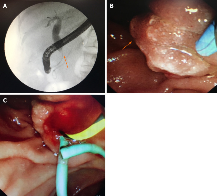 Endoscopy findings. A: Endoscopic retrograde cholangiopancreatography showed dilatation of the common bile duct and stenosis of the distal common bile duct (arrow); B: Edema of the ampulla; C: Implanted plastic stent.