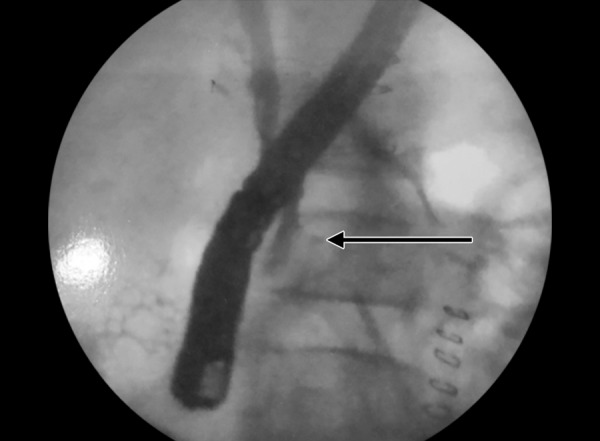 Cholangiogram showing CBD discontinuity and bile extravasation