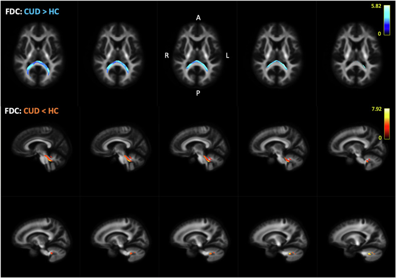 Fixel-Based Analysis: differences in fibre density and cross-section (FDC) values were observed between individuals with CUD and healthy non-users. Participants with CUD had higher FDC across the splenium of the corpus callosum (shown in blue-dark blue, slice number 15 with 2 mm increment), but lower FDC in the right cerebellum (shown in yellow-red, starting slice number 36 with 2 mm increment). Scale reflects test statistic values across significant voxels (FWE-corrected, p < 0.05).