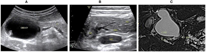 Images of a representative type A of PBM. (A) US transverse scan showed the dilated CBD containing the protein plugs; (B) US transverse scan showed the PD joining the terminal stenotic CBD within pancreas to form a common channel which drains into the duodenum; (C) MRCP indicated the dilated CBD with a narrow distal end joining the common channel.