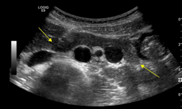 Ultrasound of the abdomen shows the pancreas is homogeneously enlarged with a mildly hypoechogenic appearance.