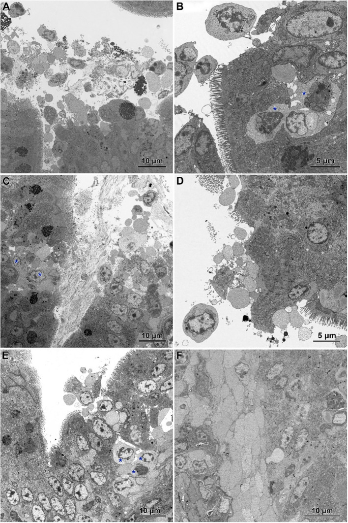 Ultrastructure of jejunum in C. perfringens infected chickens receiving CBD (A, B), CBD + nano-Se (C, D), and nano-Se (E, F). (A) Necrotic cells and cellular debris over the injured part of the intestinal epithelium. (B) Abnormal epithelium with irregular-shaped enterocytes without microvilli and numerous inflammatory cells (asterisks). (C) Necrotic foci covered by cellular debris. Note inflammatory cells (asterisks). (D) Enterocytes with irregular shape and arrangement. Note the sparse presence of microvilli. (E) Infiltration of the injured epithelium by inflammatory cells (asterisks). (F) Inflammatory cells with foam cytoplasm inside the villus.