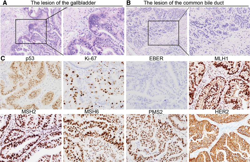 Histopathological analysis of the resected lesions. (A,B) HE staining was used to evaluate the gallbladder mass (A) and the common bile duct lesion (B). (C) Immunohistochemistry was implemented to evaluate the markers in gallbladder cancer, including p53, MLH1, MSH2, MSH6, PMS2, Ki-67, Her-2, and EBER. EBER = Epstein–Barr virus-encoded RNA.