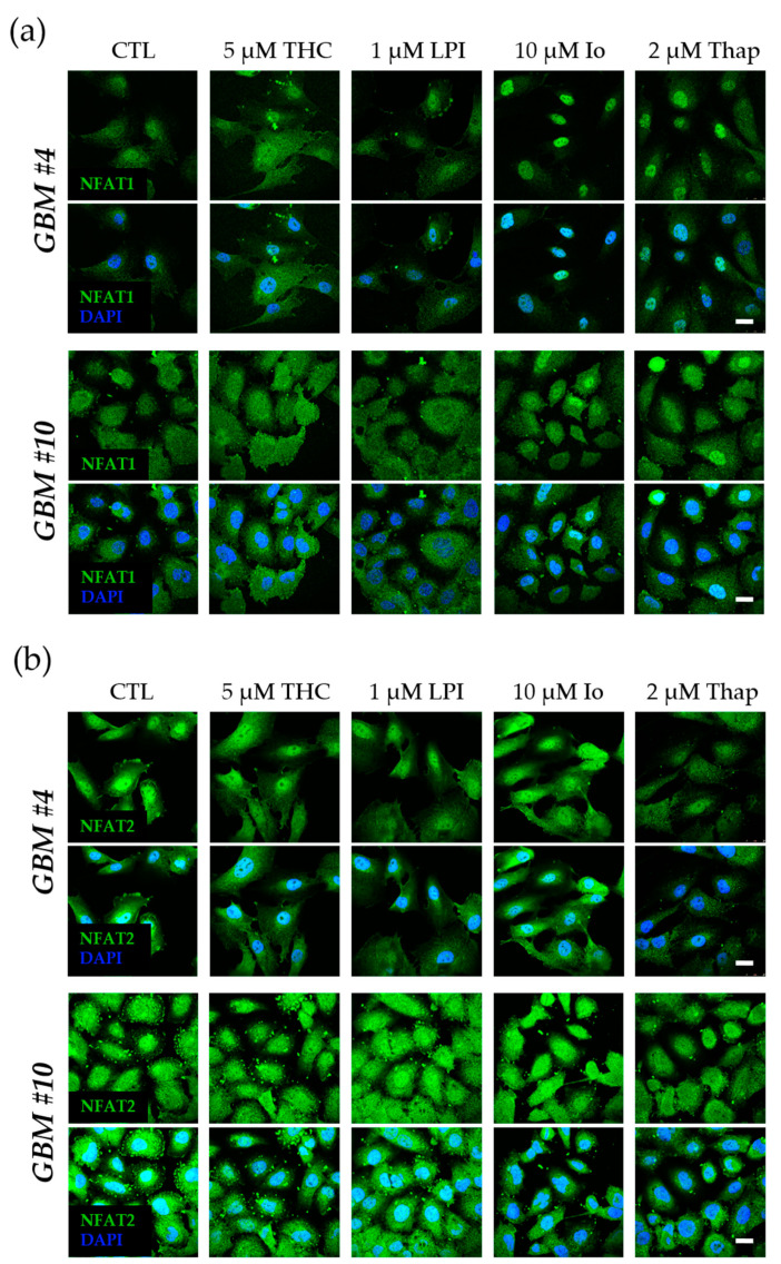 Influence of THC and LPI on the subcellular localization of NFAT1 and NFAT2 after 30 min. Representative images of NFAT1 (a) and NFAT2 (b) after 30 min of THC and LPI stimulation. In untreated control cells, NFAT1 (a) and NFAT2 (b) were localized in both the cytoplasm and nucleus. Translocation of NFAT1 (a) and NFAT2 (b) after THC or LPI administration was not detectable in GBM #4 or GBM #10. Increased signals of nuclear NFAT1 (a) were observed after ionomycin (Io) and thapsigargin (Thap) in both cell lines. In contrast, signals of NFAT2 (b) remained unchanged. Cell nuclei were counterstained with DAPI. Scale bar = 25 µm.