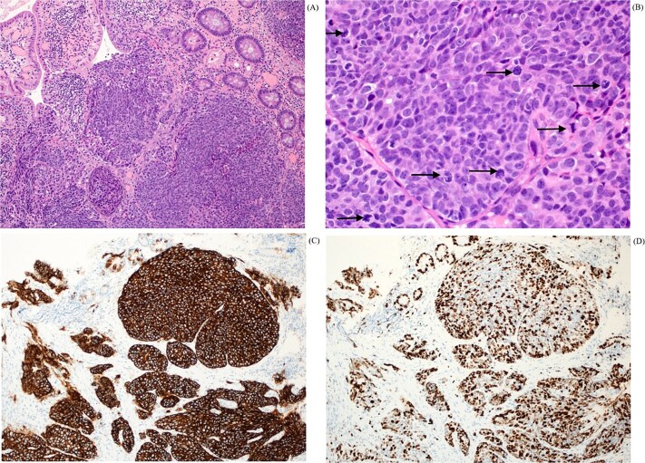 Histopathological findings in H&E x 4 (A) shows variable sized nests of tumor in the lamina propria. H&E x 40 with mitosis (B) shows nuclear pleomorphism with frequent mitotic activity (black arrows). The tumor cells are strongly and diffusely positive for synaptophysin (C) and Ki-67 immunostain (D) displaying high proliferative index of more than 70%.