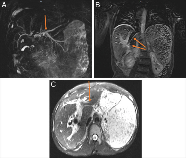 Magnetic resonance imaging of the abdomen and pelvis (T2 haste) showing a column of air within the TIPS stent and fistulous connection between the TIPS and CBD stents in different views: (a) intrahepatic biliary ductal dilation (MRCP 3D reconstruction), (b) the TIPS stent with intraluminal air (upper arrow) and concern for fistulous connection with the CBD stent (lower arrow) (axial view), and (c) the TIPS stent with intraluminal air (coronal view). CBD, common bile duct; MRCP, magnetic resonance cholangiopancreatography; TIPS, transjugular intrahepatic portosystemic shunt.