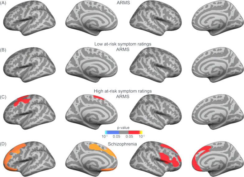 Significant grey matter thickness differences between (A) ARMS, B low symtpmatic ARMS, and C high symptomatic ARMS and D the SCZ group versus their matched HC counter parts, respectively, using a frontal–temporal mask. Multiple comparison correction was performed using permutation testing of 100,000 tests with a cluster-forming threshold of p < .05 and cluster-wise threshold of p < .05 with an additional Bonferroni correction to take both hemispheres into account. (Red = greater grey matter thickness in HC)