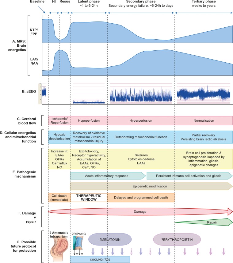 Schematic diagram illustrating the different pathological phases of cerebral injury after cerebral HI. The primary phase (acute HI), latent phase, secondary energy failure phase and tertiary brain injury phase are shown. (A) Magnetic resonance spectra showing the biphasic pattern of NTP/EPP decline and lactate/NAA increase during primary and secondary phases following HI insult. Persisting lactic alkalosis is shown in tertiary phase. (B) Amplitude-integrated EEG showing normal trace at baseline, flat tract following HI, burst-suppression pattern in latent phase, emergence of seizures in secondary phase and normalisation with sleep–wake cycling in tertiary phase. (C) Following HI, there is a period of hypoperfusion associated with hypometabolism during latent phase, followed by relative hyperperfusion in secondary phase. (D) Cellular energetics and mitochondrial function are reflected in the biphasic response shown on magnetic resonance spectroscopy (A), with a period of recovery in latent phase followed by deterioration in secondary phase. There is partial recovery in tertiary phase. (E) The most important pathogenic changes are shown for each phase (see main text for description), including generation of toxic free radical species, accumulation of EAAs, cytotoxic oedema, seizures and inflammation. Cell lysis occurs immediately following HI, while programmed cell death occurs in secondary phase; latent phase provides a therapeutic window. Persisting inflammation and epigenetic changes impede long-term repair. (F) Damage is maximal in the secondary phase, but persists into the tertiary phase as inflammation and gliosis evolve. (G) In the future, neuroprotective treatments are likely to involve a ‘cocktail’ of therapies to be administered intrapartum, in the latent phase to prevent secondary energy failure and through secondary and tertiary phases to offset evolving damage. HI, hypoxia-ischaemia; EAAs, excitatory amino acids; EPP, exchangeable phosphate pool; NAA, N-acetylaspartate; NO, nitric oxide; NTP, nucleoside triphosphate (this is mainly ATP); OFRs, oxygen free radicals; RIPostC, remote ischaemic postconditioning.