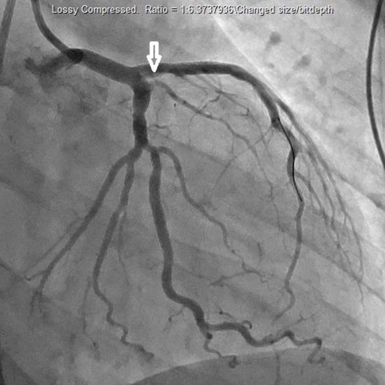 Cardiac catheterization demonstrating revascularization of left anterior descending artery.