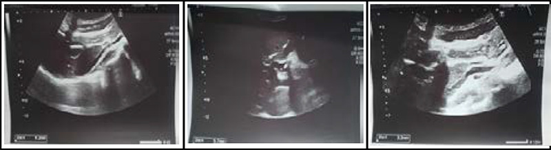 Abdominal USG showing a dilated CBD and choledocholithiasis