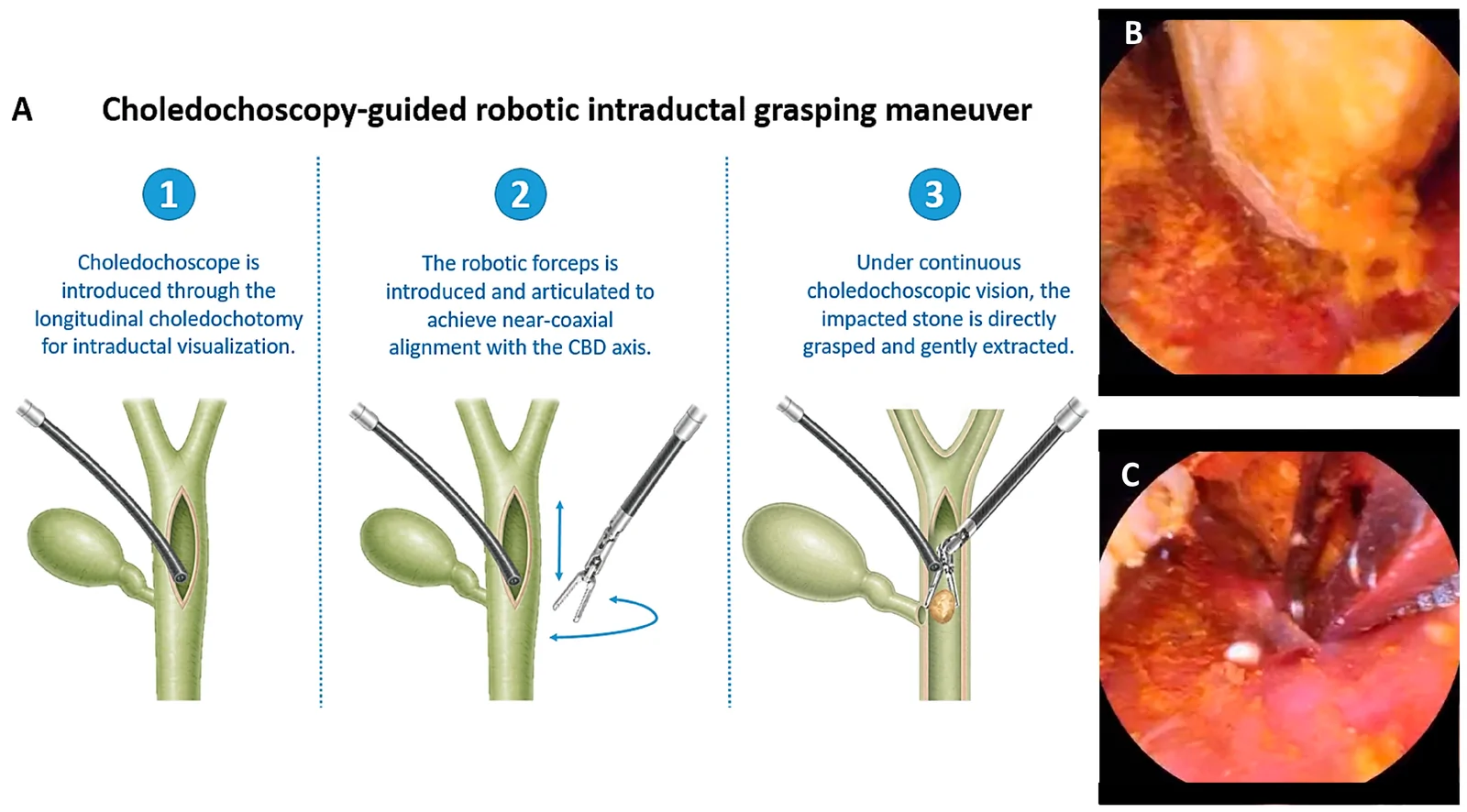 Choledochoscopy-guided robotic intraductal grasping maneuver. (A) Schematic representation of the three main steps of the maneuver. (1) The choledochoscope is introduced through the longitudinal choledochotomy to provide direct intraductal visualization. (2) The wristed robotic forceps is then introduced independently through the choledochotomy and articulated to achieve near-coaxial alignment of the jaws with the common bile duct (CBD) axis. The blue arrows indicate the direction of instrument articulation. (3) Under continuous choledochoscopic visualization, the impacted stone is directly grasped and gently extracted. (B) Choledochoscopic view showing the stone impacted at the cystic duct–CBD junction after unsuccessful conventional basket retrieval. (C) Direct grasping of the impacted stone with the 8-mm fenestrated bipolar forceps under continuous choledochoscopic visualization.